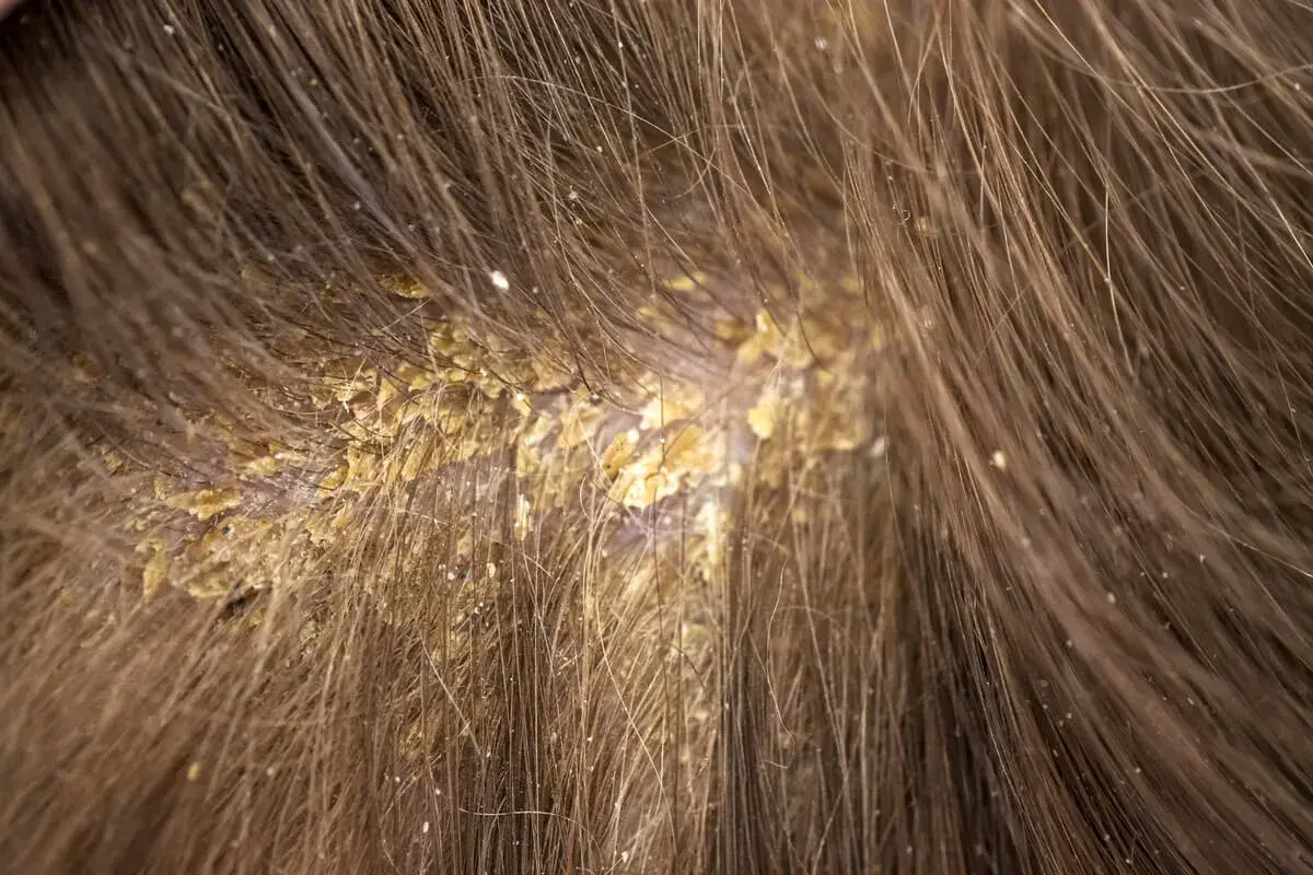 Primer plano de costras amarillentas y escamas en el cuero cabelludo, rodeadas de cabello castaño.