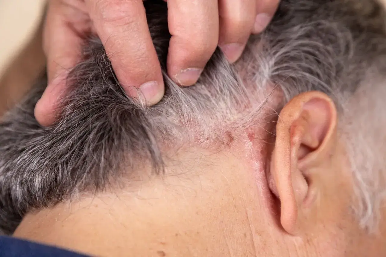 Dedos separan cabello gris mostrando escamas y enrojecimiento, indicando posible tiña en el pelo.