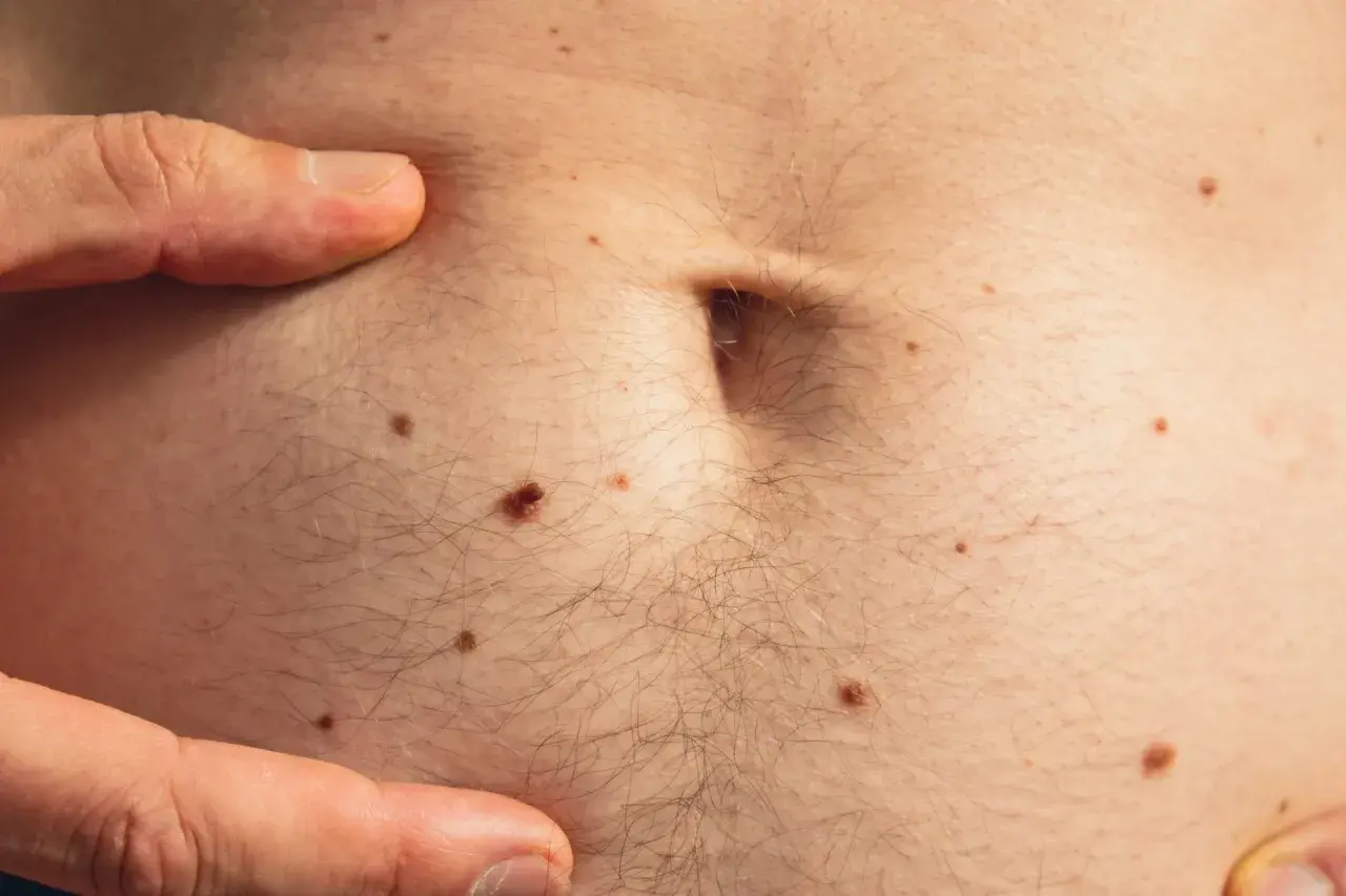 Un dedo señala la piel del abdomen, cubierta de lunares y vello. Se observa un pequeño quiste de grasa.