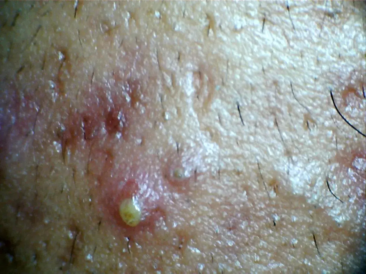 Primer plano de una pustula con pus amarillo, rodeada de piel enrojecida y vello oscuro.