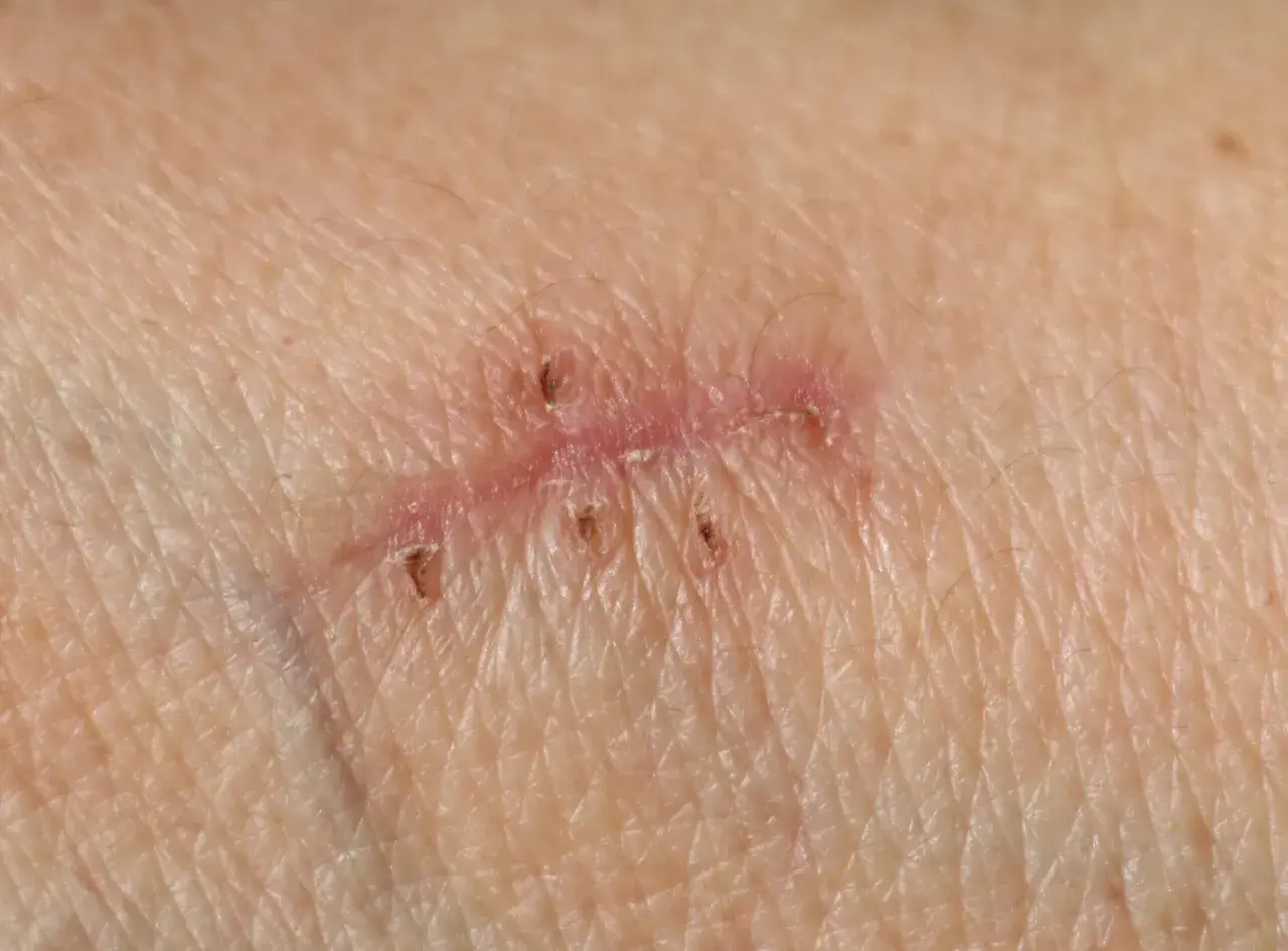 Piel con varias cicatrices, algunas con puntos de sutura visibles.