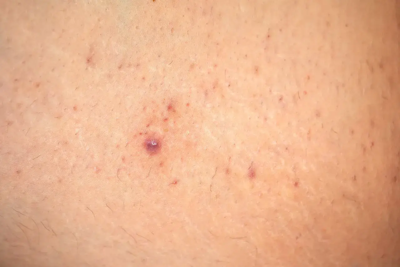 Primer plano de piel con pequeñas imperfecciones y vello fino, con una zona que recuerda a la piel de fresa.