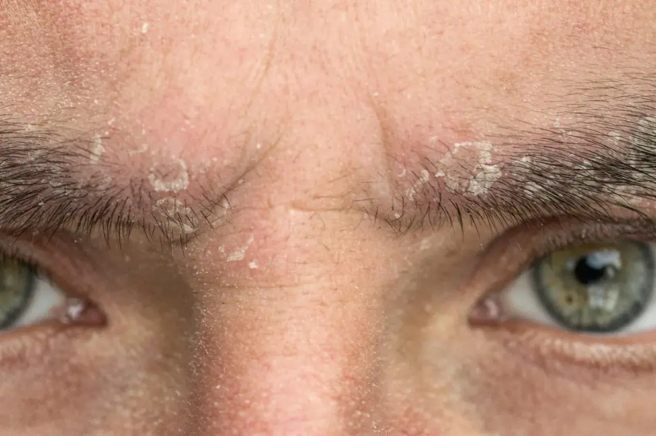 Primer plano de la frente y ojos de una persona con escamas blancas y piel irritada, indicativo de seborrea.