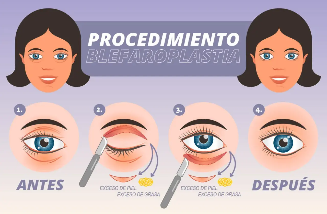 Ilustración del procedimiento de blefaroplastia para corregir párpados caídos, mostrando antes y después.