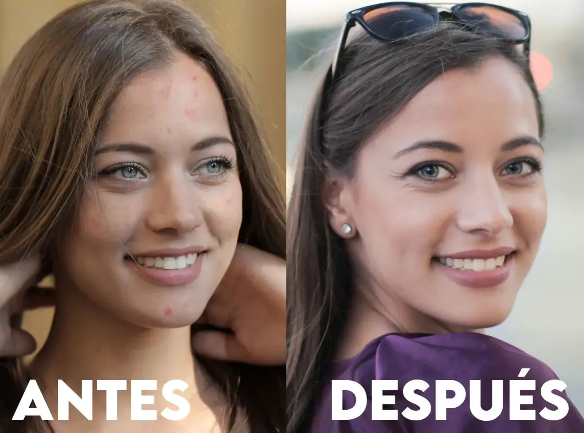 Antes y después de un tratamiento para el acné. La piel de la mujer luce más limpia y radiante, mostrando los beneficios de deripil.