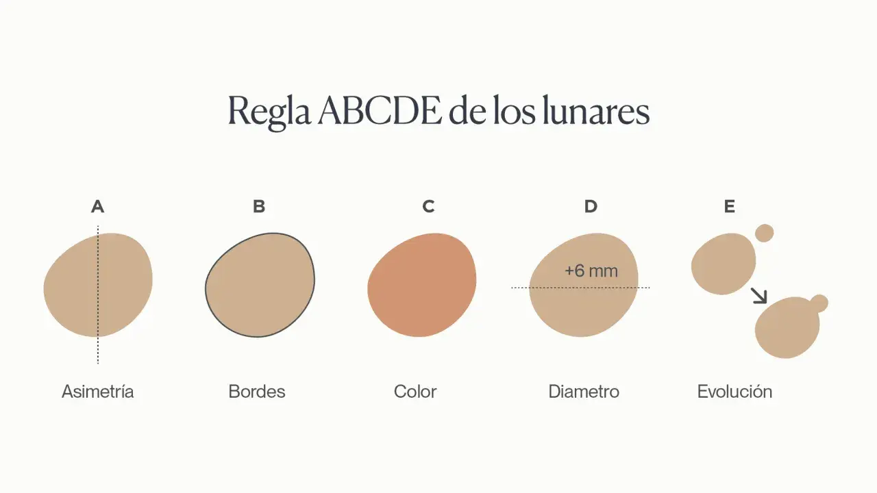 Regla ABCDE para identificar lunares malignos: Asimetría, Bordes irregulares, Color variado, Diámetro mayor a 6mm y Evolución.