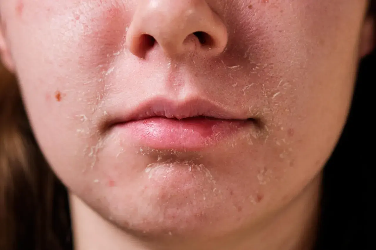 Primer plano de piel facial con descamación y enrojecimiento alrededor de la nariz y la boca.