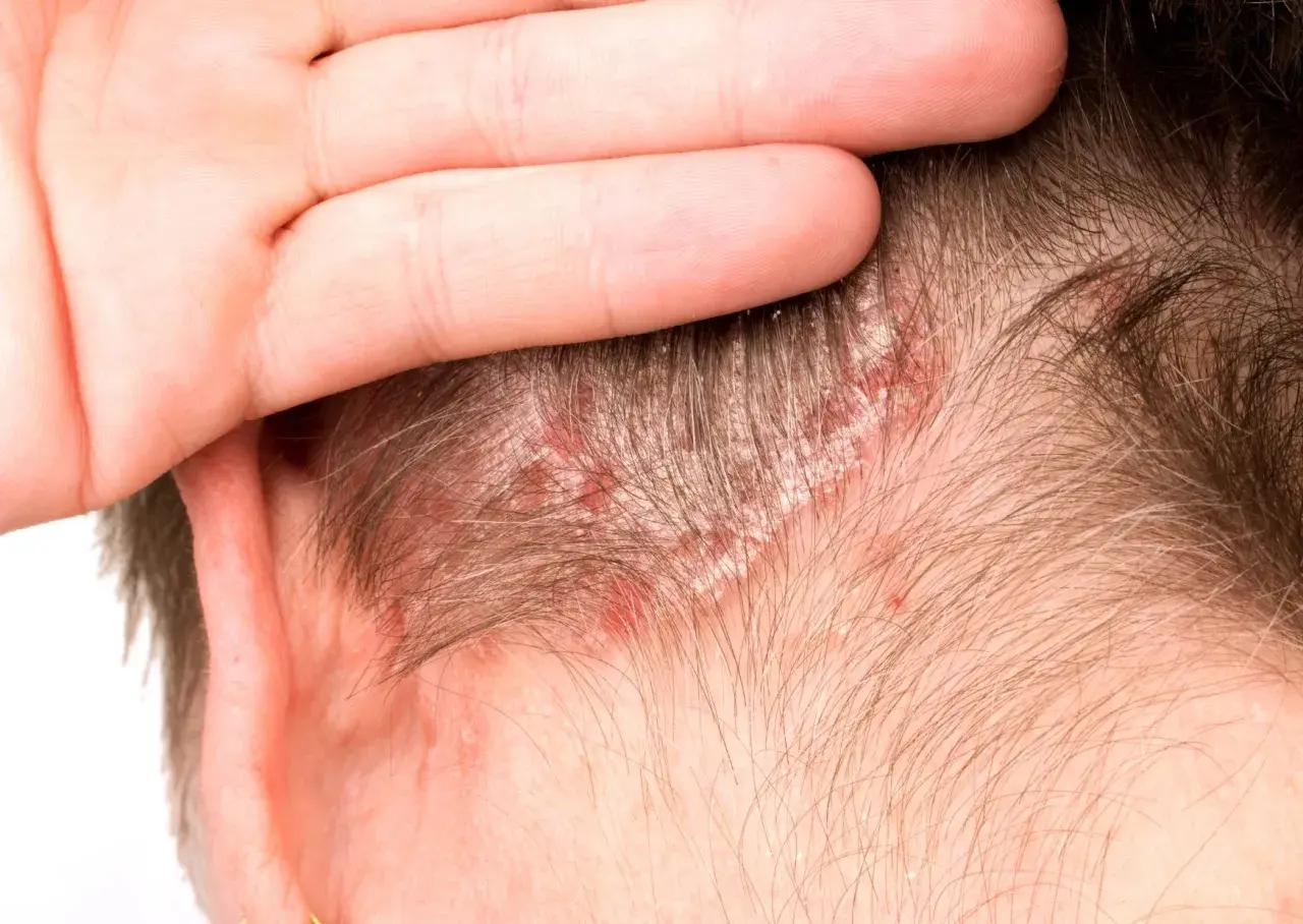Una mano cubre parte de la cabeza, revelando un cuero cabelludo irritado con enrojecimiento y escamas blancas.