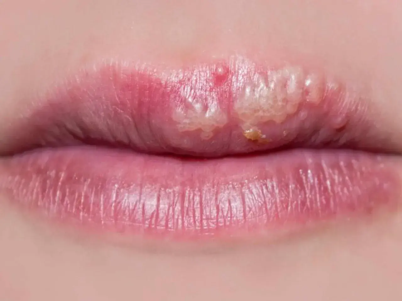 Labios con ampollas y costras, posiblemente tratables con ácido fusídico.