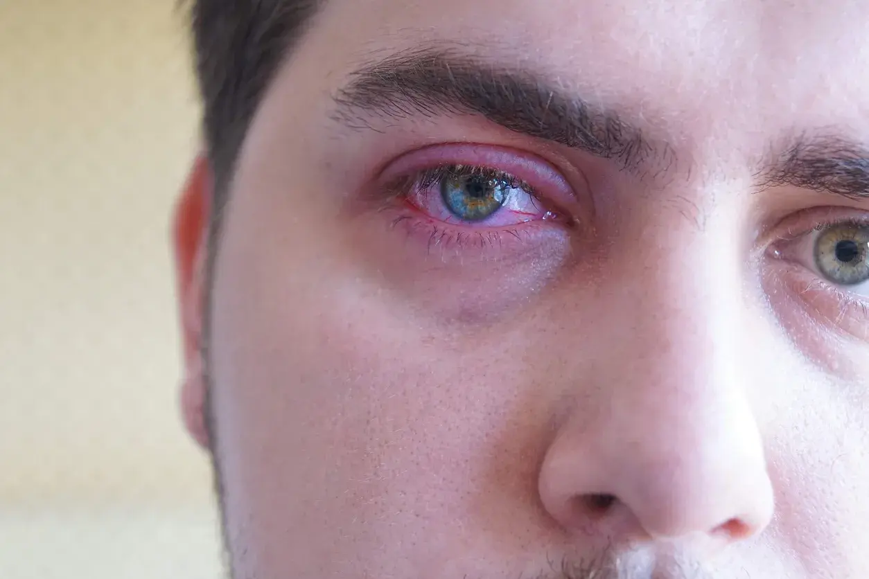 Ojo irritado con una pequeña bolita granito en la línea de agua. El párpado está enrojecido y la conjuntiva inflamada.