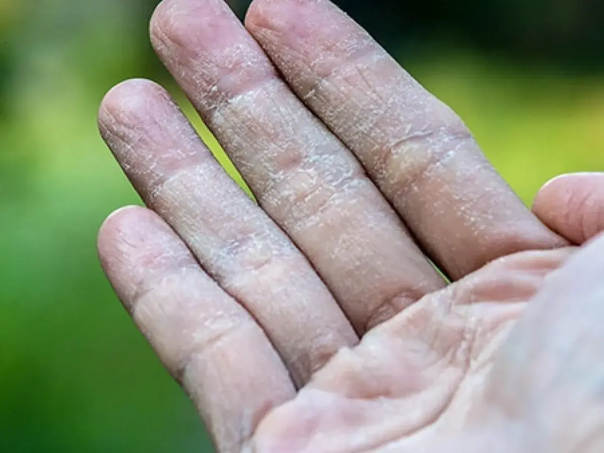 Dedos con piel seca y agrietada, síntoma de dishidrosis.