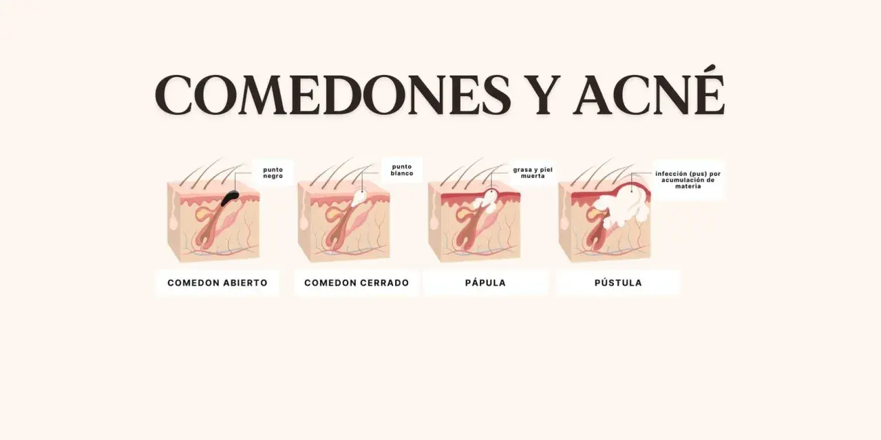 Ilustración de la piel mostrando un punto negro enquistado, un punto blanco, pápula y pústula, explicando el acné.