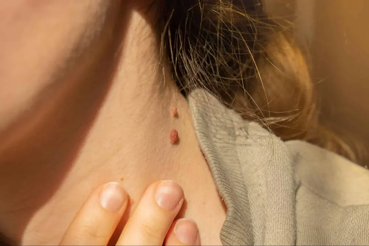 Primer plano de dos verrugas en el cuello, una más grande que la otra. Se busca información sobre cómo quitar verrugas cuello.