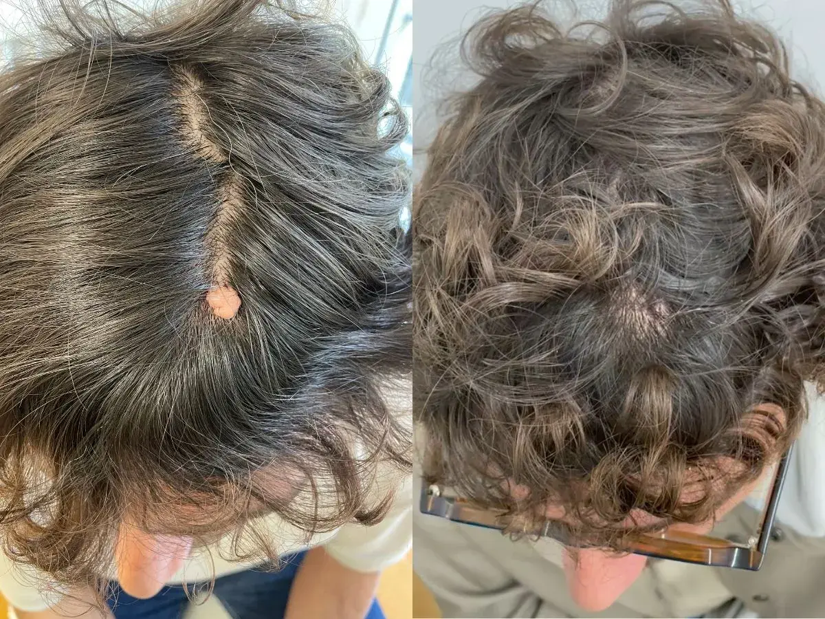 Comparación de verrugas en la cabeza antes y después del tratamiento.
