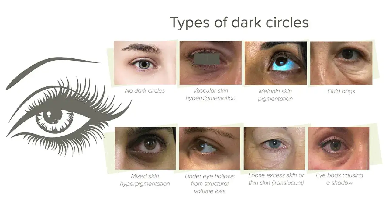Muestra diferentes tipos de ojeras: vasculares, por melanina, bolsas de fluidos, huecos bajo los ojos y piel suelta.