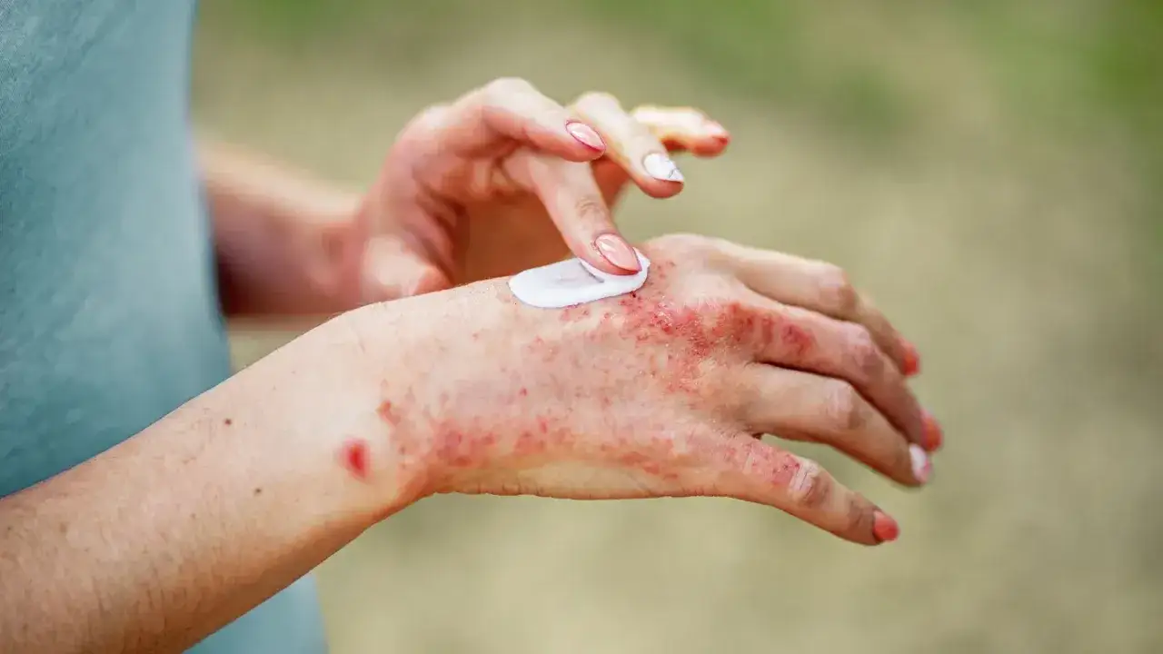 Manos con dermatitis, rojas y con erupciones, aplicando crema para aliviar la irritación.
