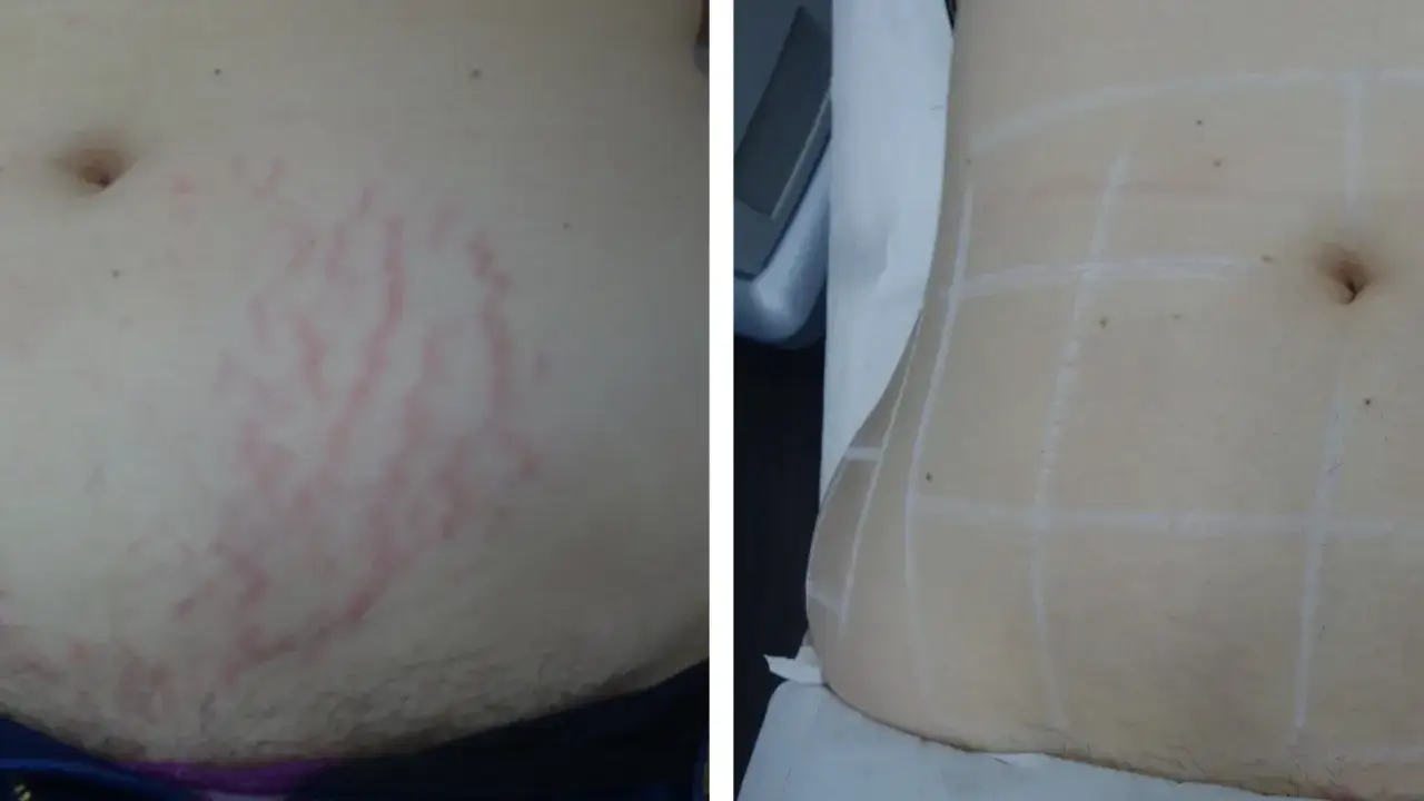 Abdomen con estrías rojas antes y después de tratamiento para como quitar estrias, con marcas de cuadrícula para el procedimiento.