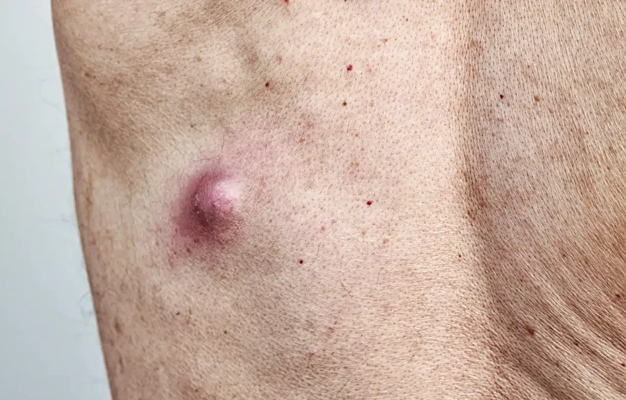 Un quiste de grasa inflamado en la piel, con enrojecimiento alrededor.