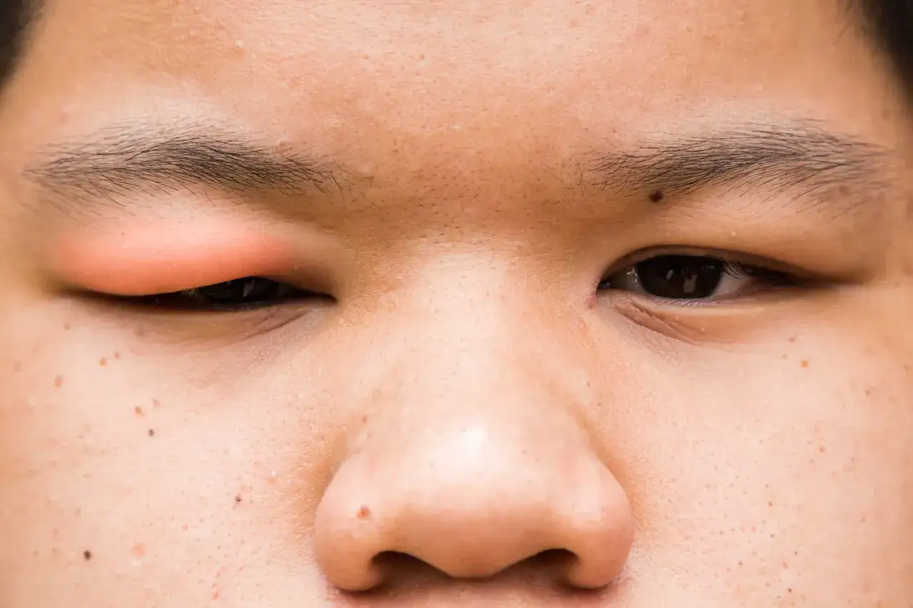 Ojo con un parpado hinchado y enrojecido. La piel alrededor de los ojos muestra pecas y poros.