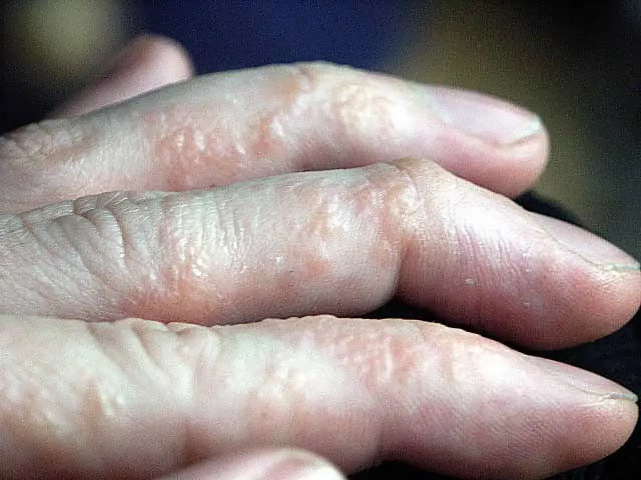 Dedos con pequeñas ampollas y piel escamosa, síntomas de dishidrosis.