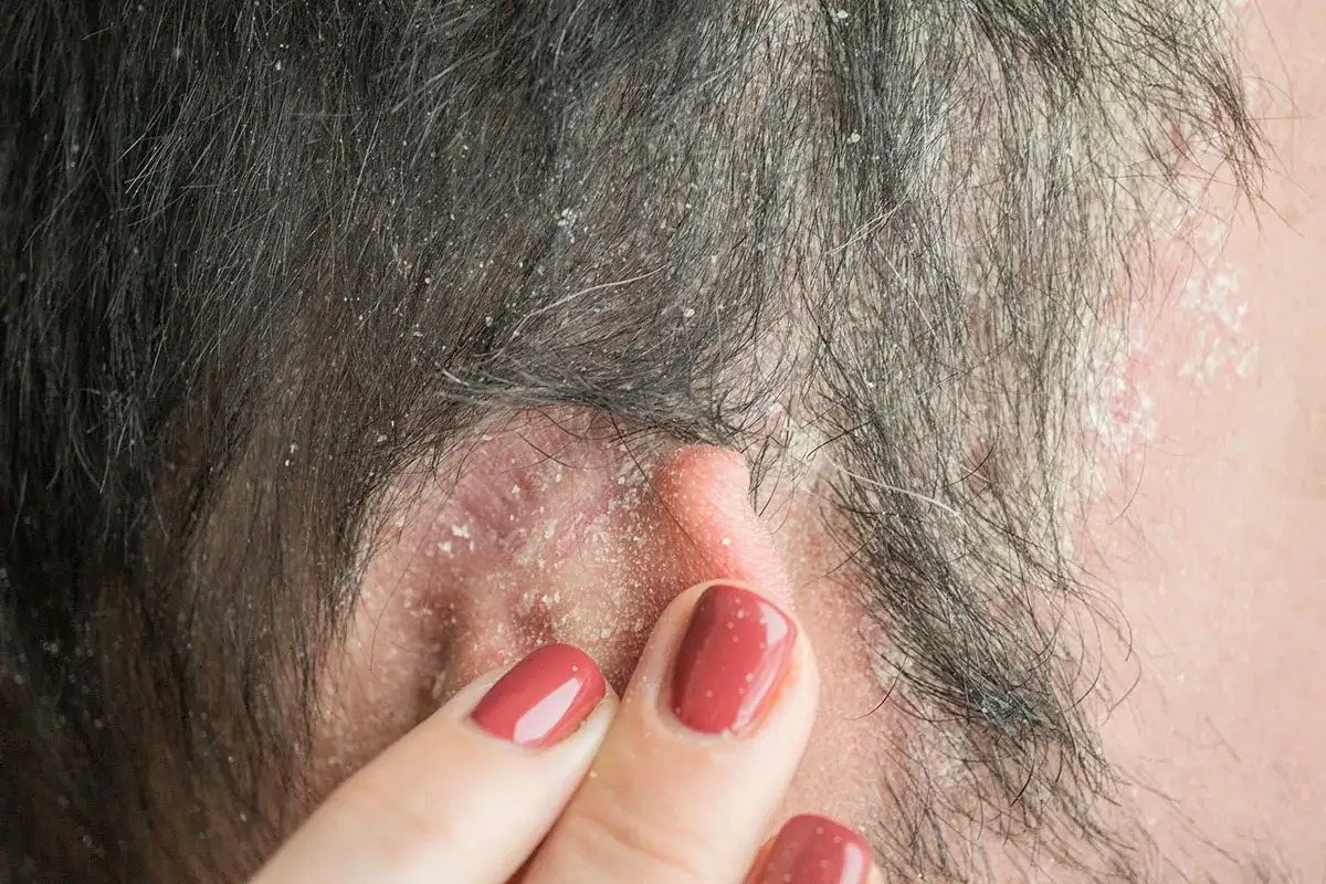Primer plano de un cuero cabelludo con dermatitis seborreica, mostrando escamas blancas y piel enrojecida cerca de la oreja.