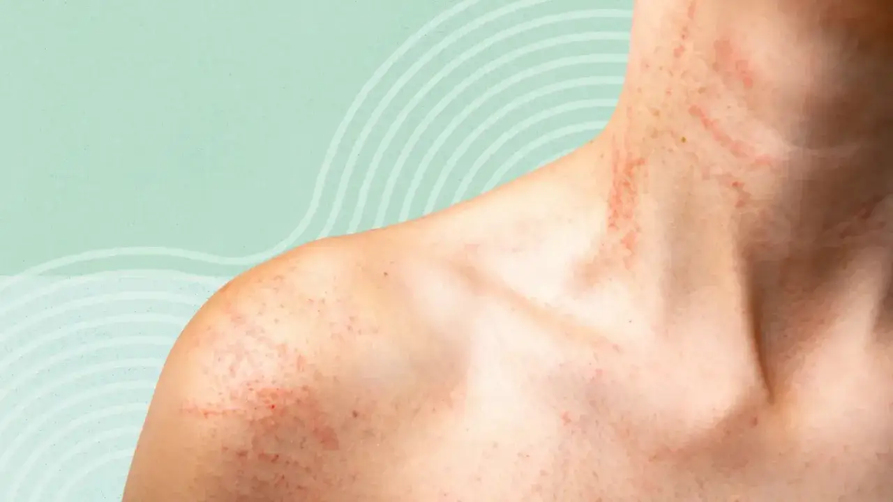 Sarpullido en la piel con picor en el cuello y hombros, con marcas rojas y pequeñas protuberancias.