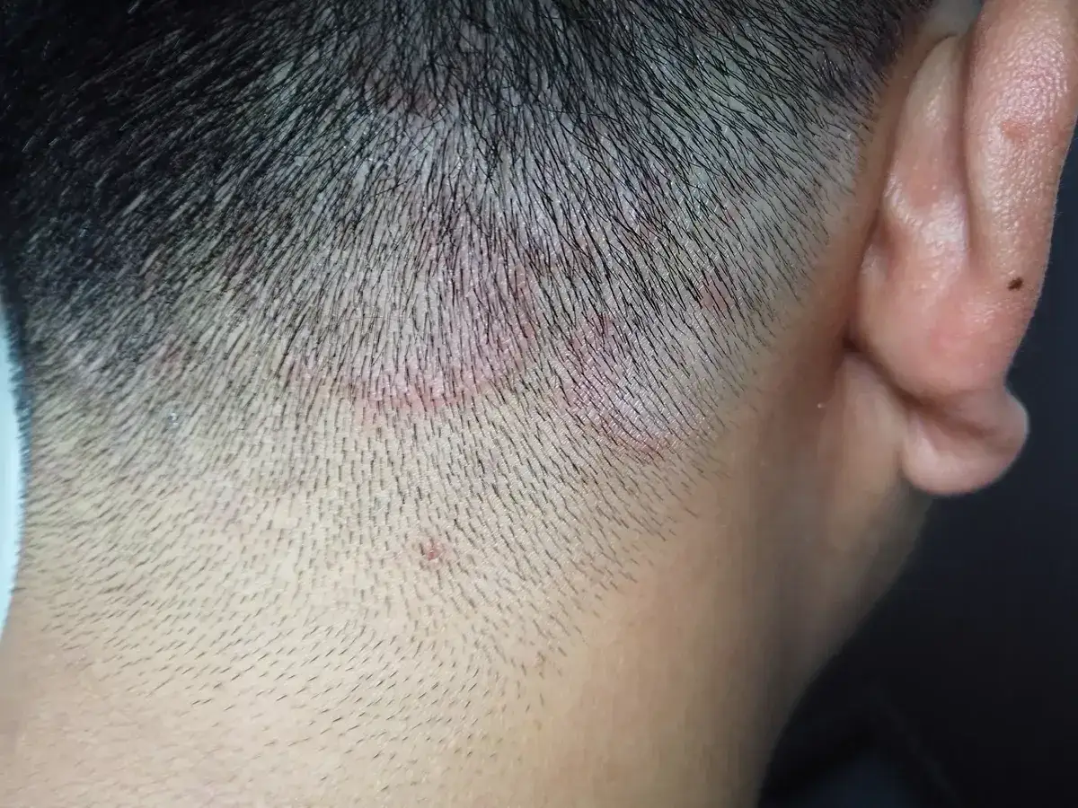 Detalle de la nuca y oreja con zonas rojizas y escamosas, sugiriendo tiña en el pelo.
