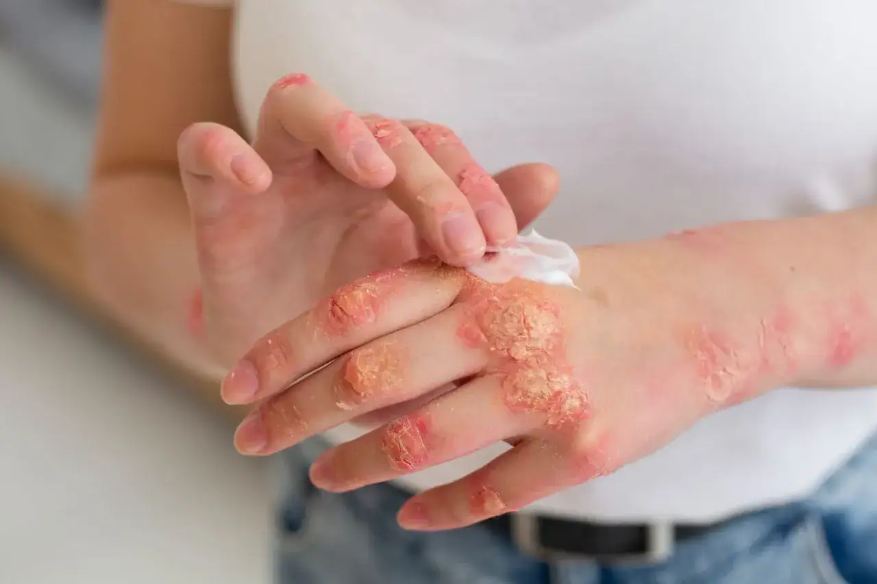 Manos con piel irritada y escamosa, aplicando crema. Podría ser útil para tratar afecciones con ácido fusídico.