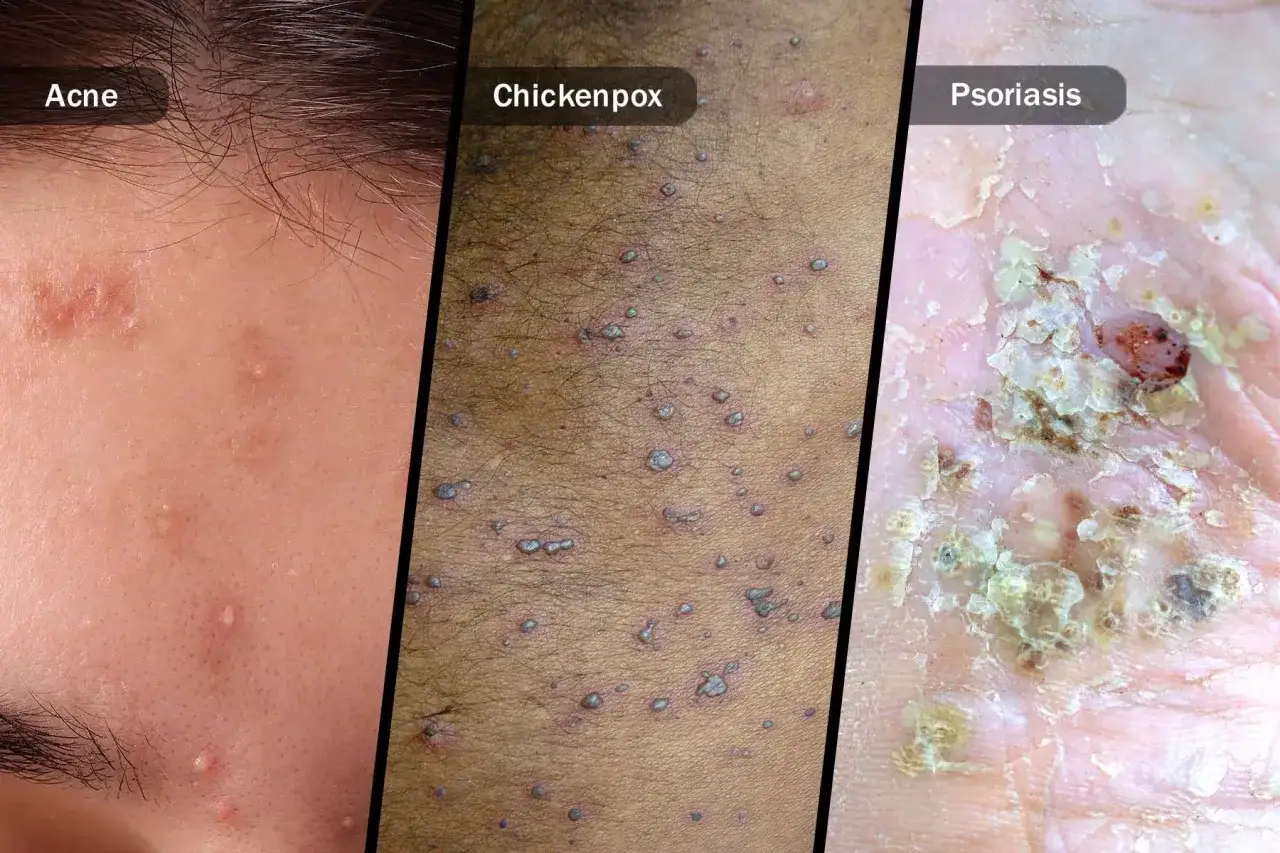 Tres imágenes de afecciones cutáneas: acné, varicela con pústulas y psoriasis.