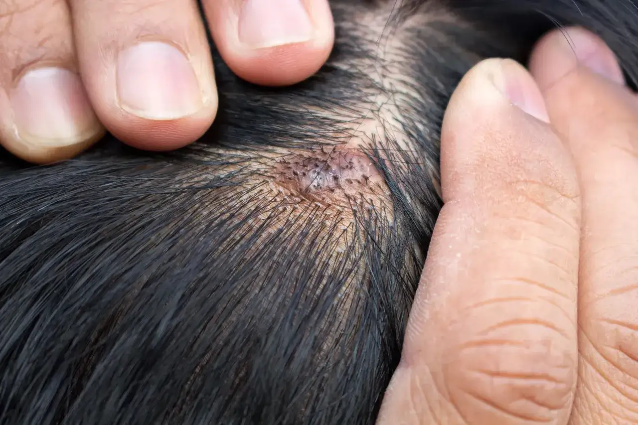 Dedos separan cabello oscuro para mostrar una lesión en el cuero cabelludo, indicando posible dolor.