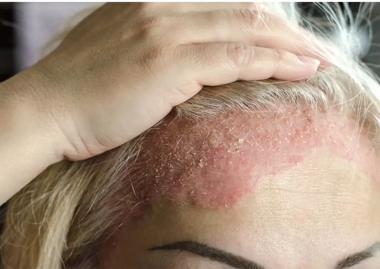 Una mano cubre parte de la frente de una persona con un área roja y escamosa, indicando eczema cara.