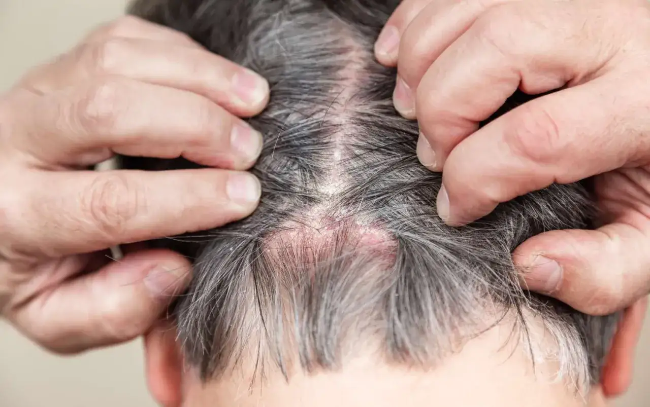 Manos separando el cabello gris para mostrar costras en el cuero cabelludo, con piel enrojecida y escamas.